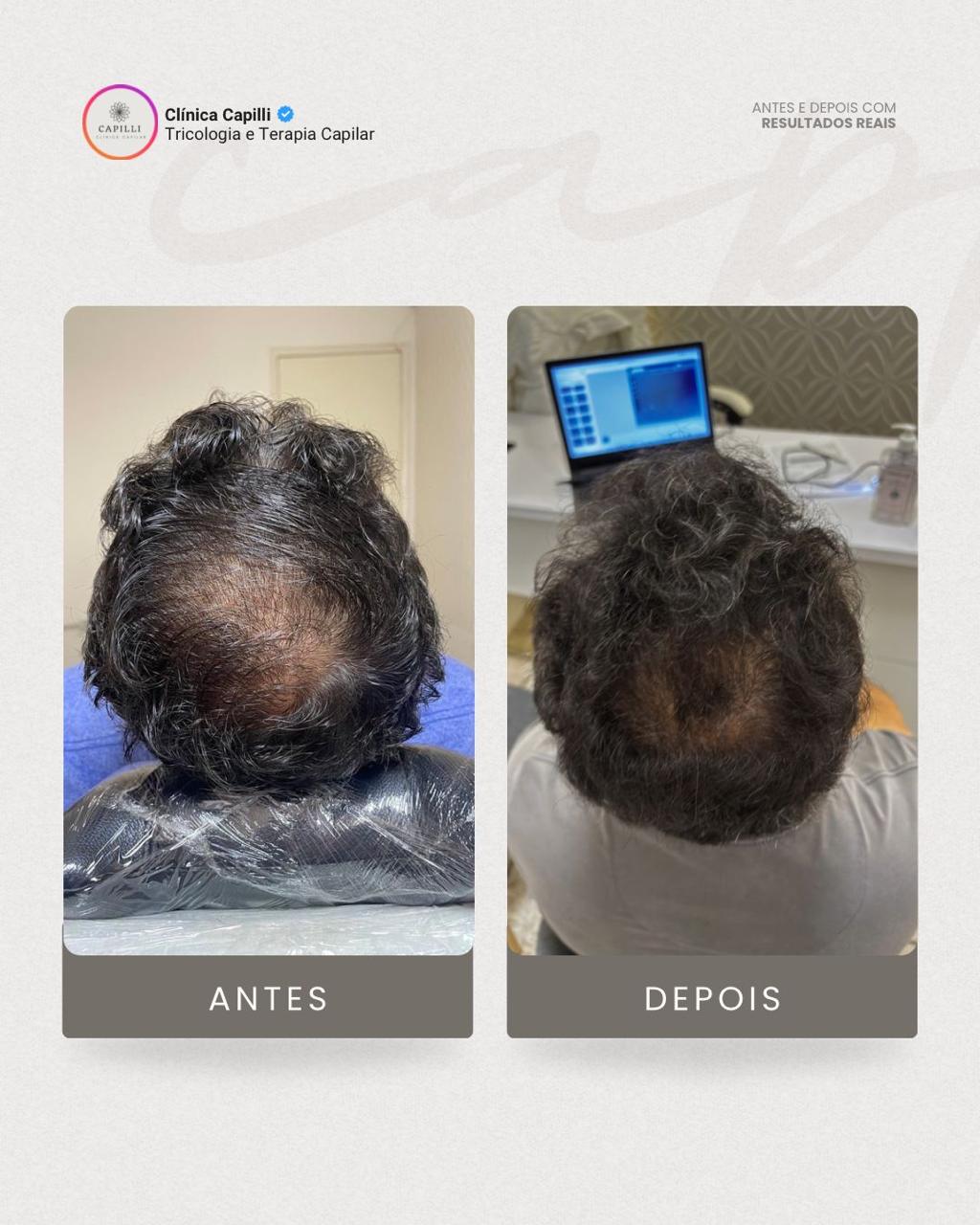 Resultado de tratamento capilar na Capilli - Queda difusa