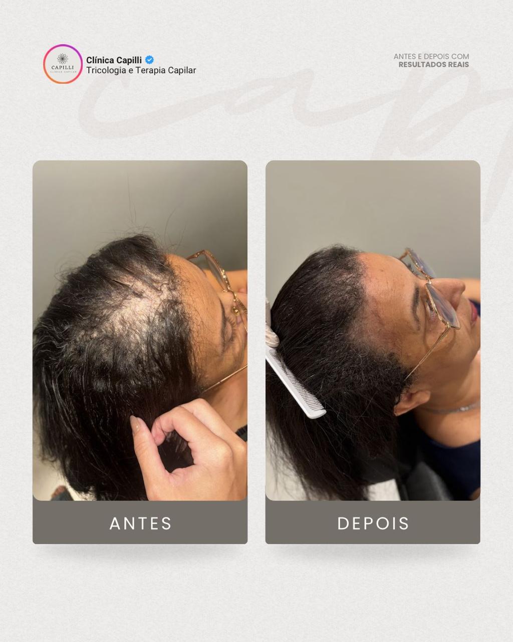 Resultado de tratamento capilar na Capilli - Tratamento capilar
