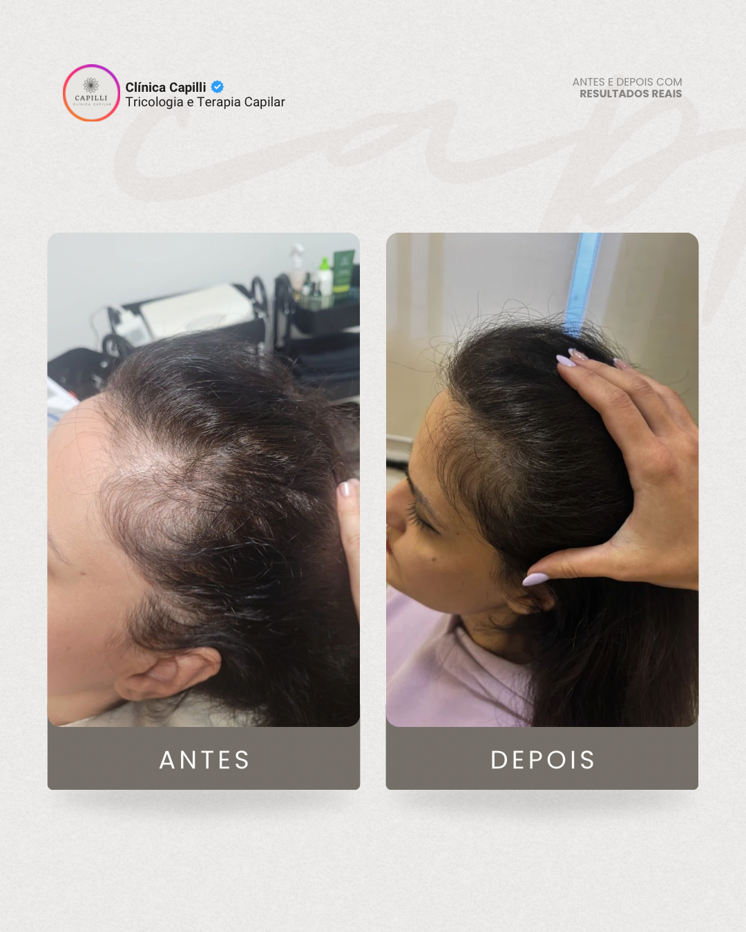 Resultado de tratamento capilar na Capilli - Densidade capilar